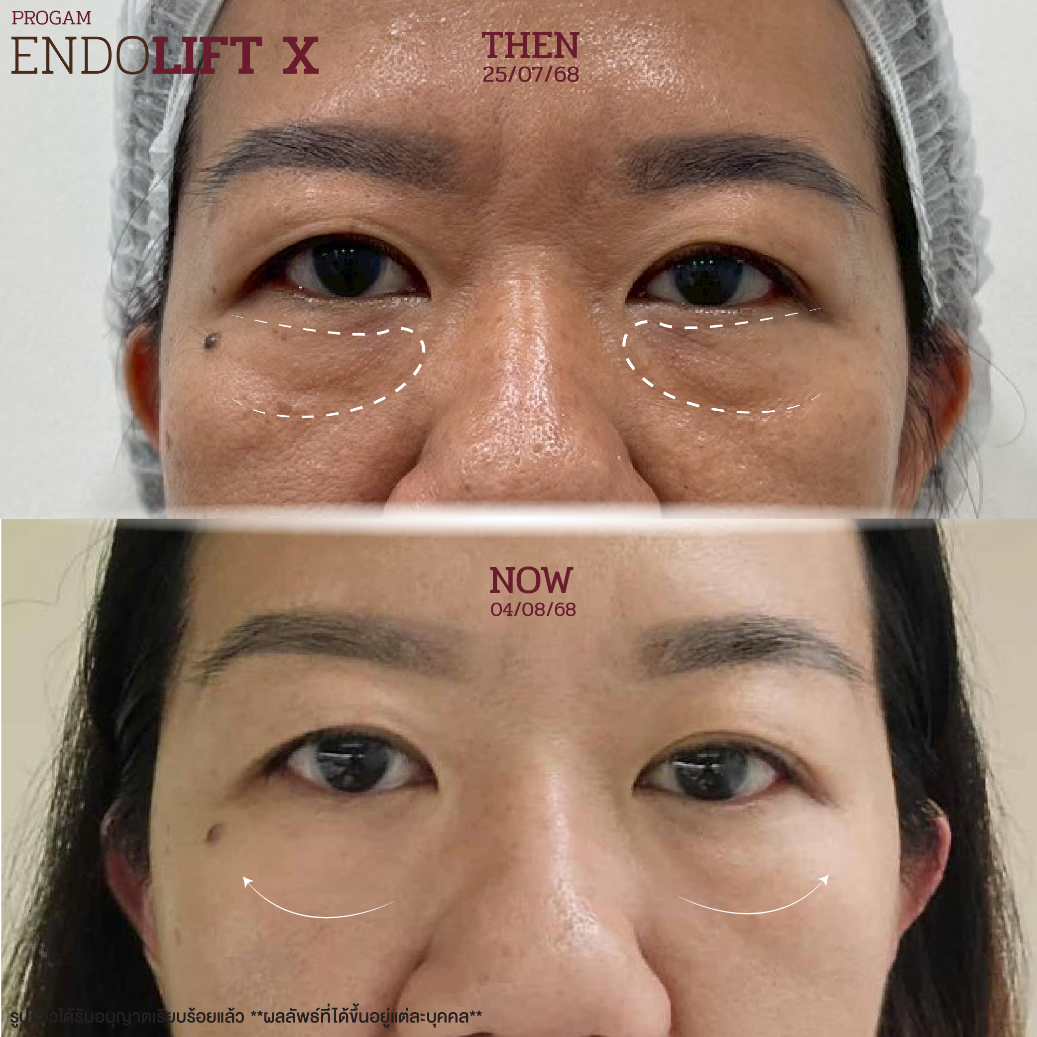 รีวิวลูกค้า Endolift X ที่ Zeniq Holistic