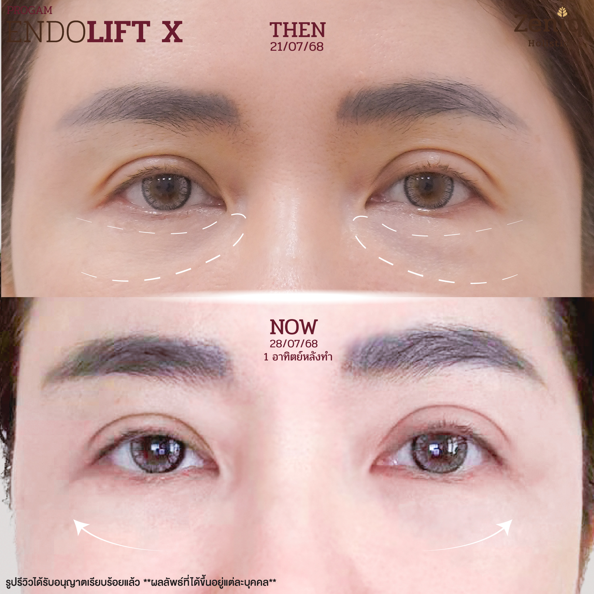 รีวิวผลลัพธ์ปรับรูปหน้า Zeniq Holistic