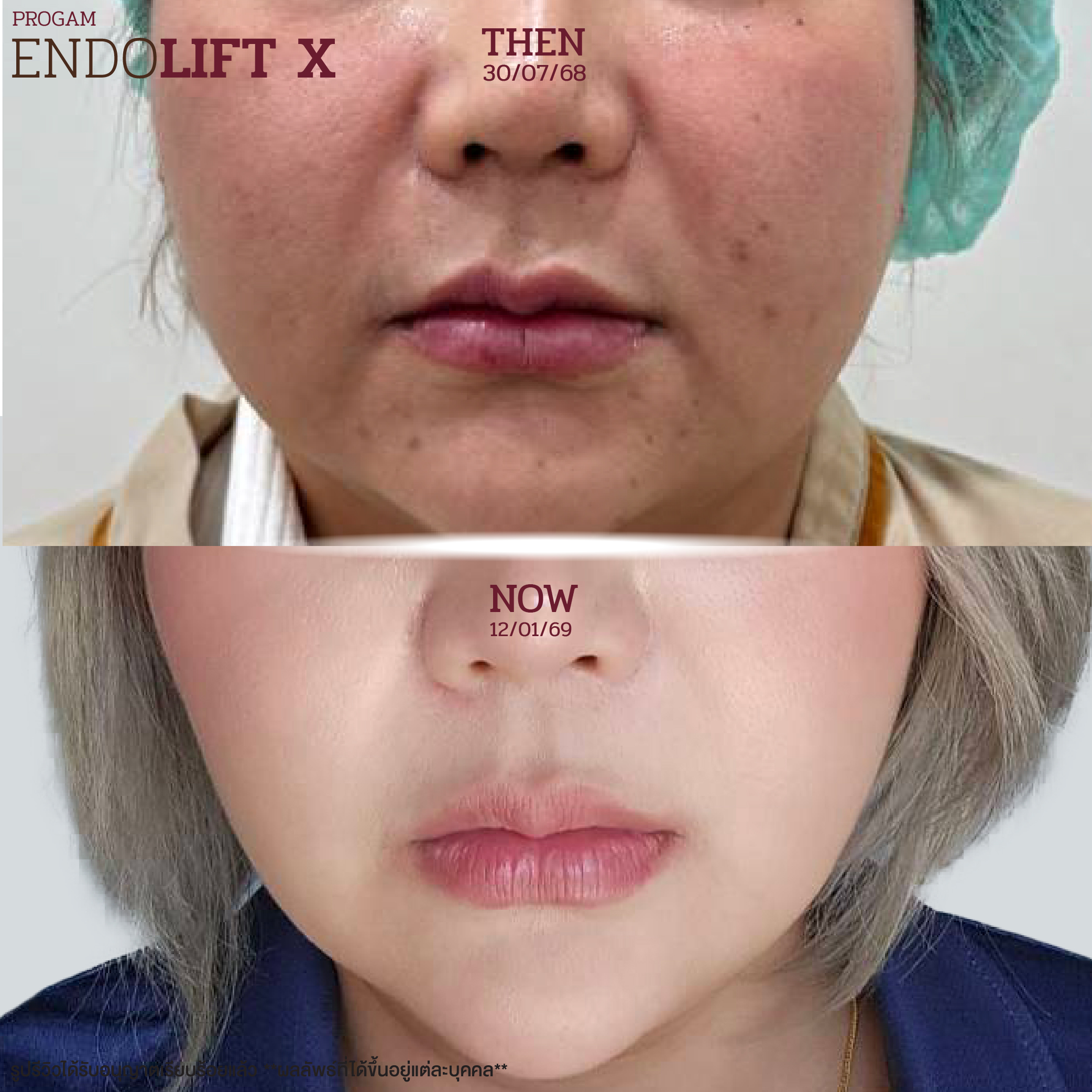 รีวิวลูกค้า Xerf ยกกระชับผิว Zeniq Holistic