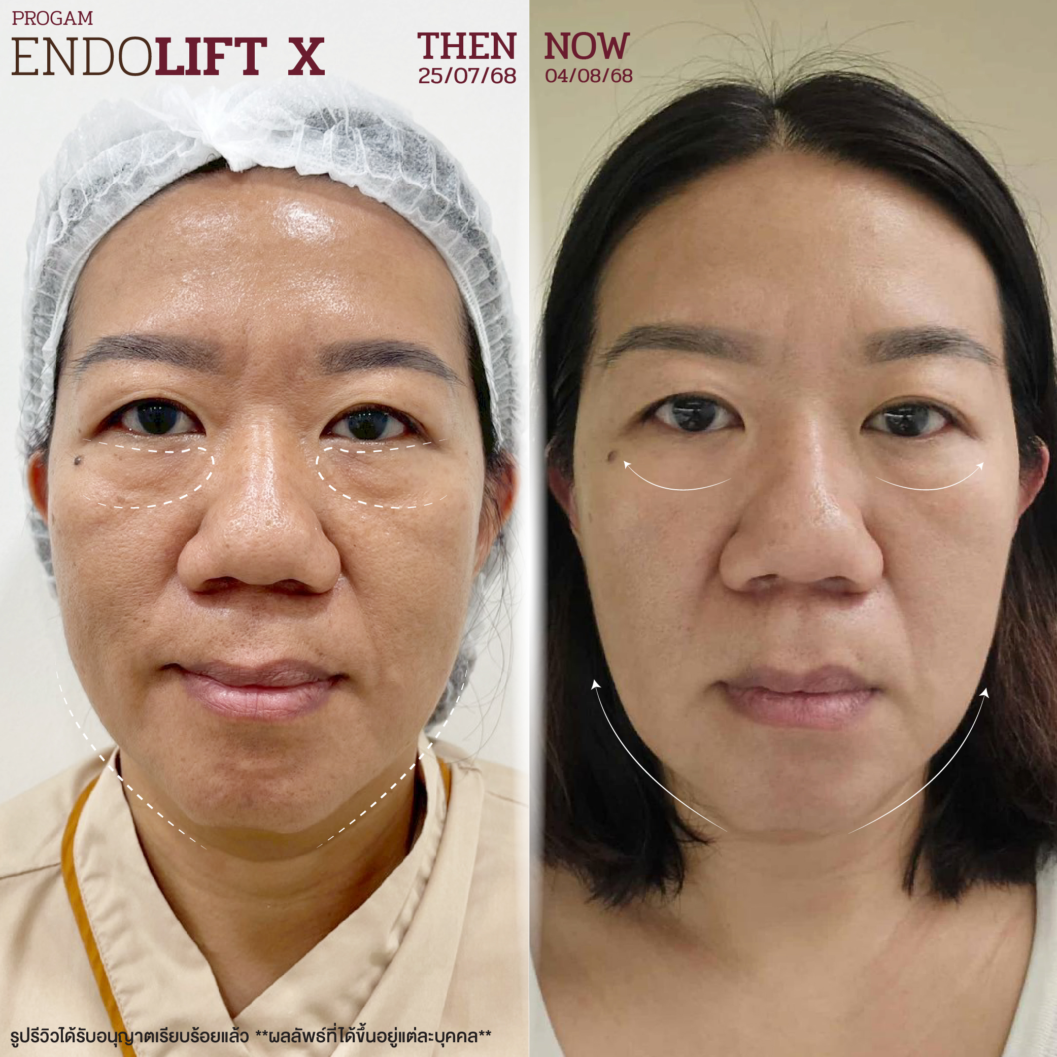 รีวิวผลลัพธ์ดูแลผิวพรรณ Zeniq Holistic