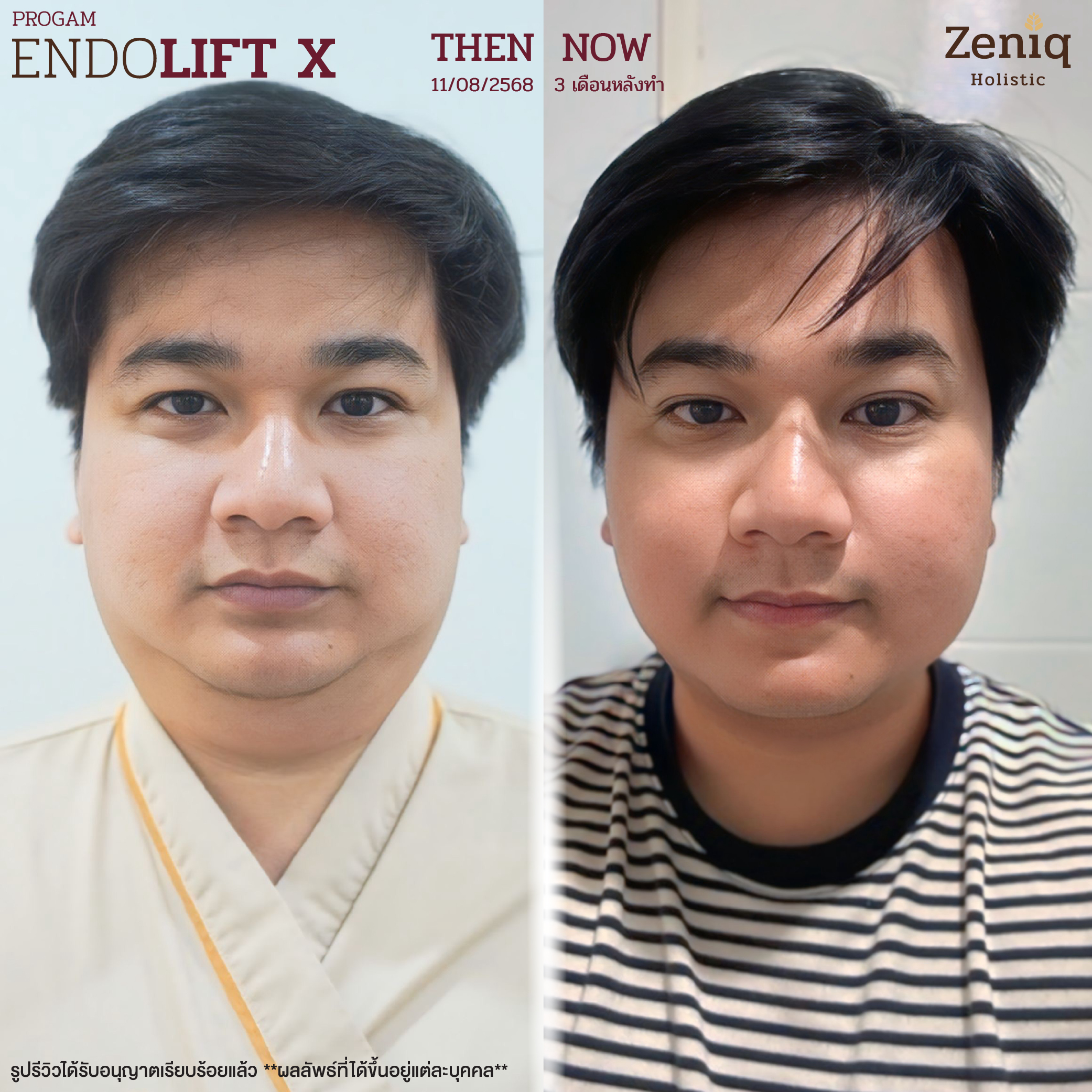 รีวิวลูกค้ายกกระชับไม่ผ่าตัด Zeniq Holistic