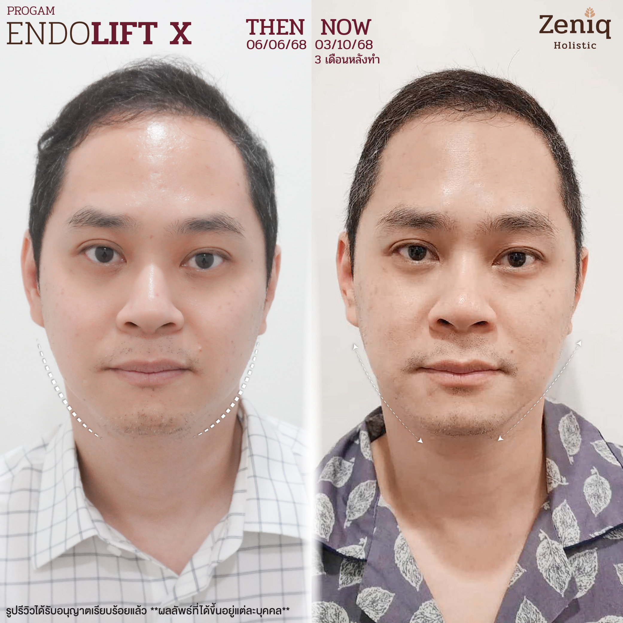 รีวิวประสบการณ์ดูแลผิว Zeniq Holistic
