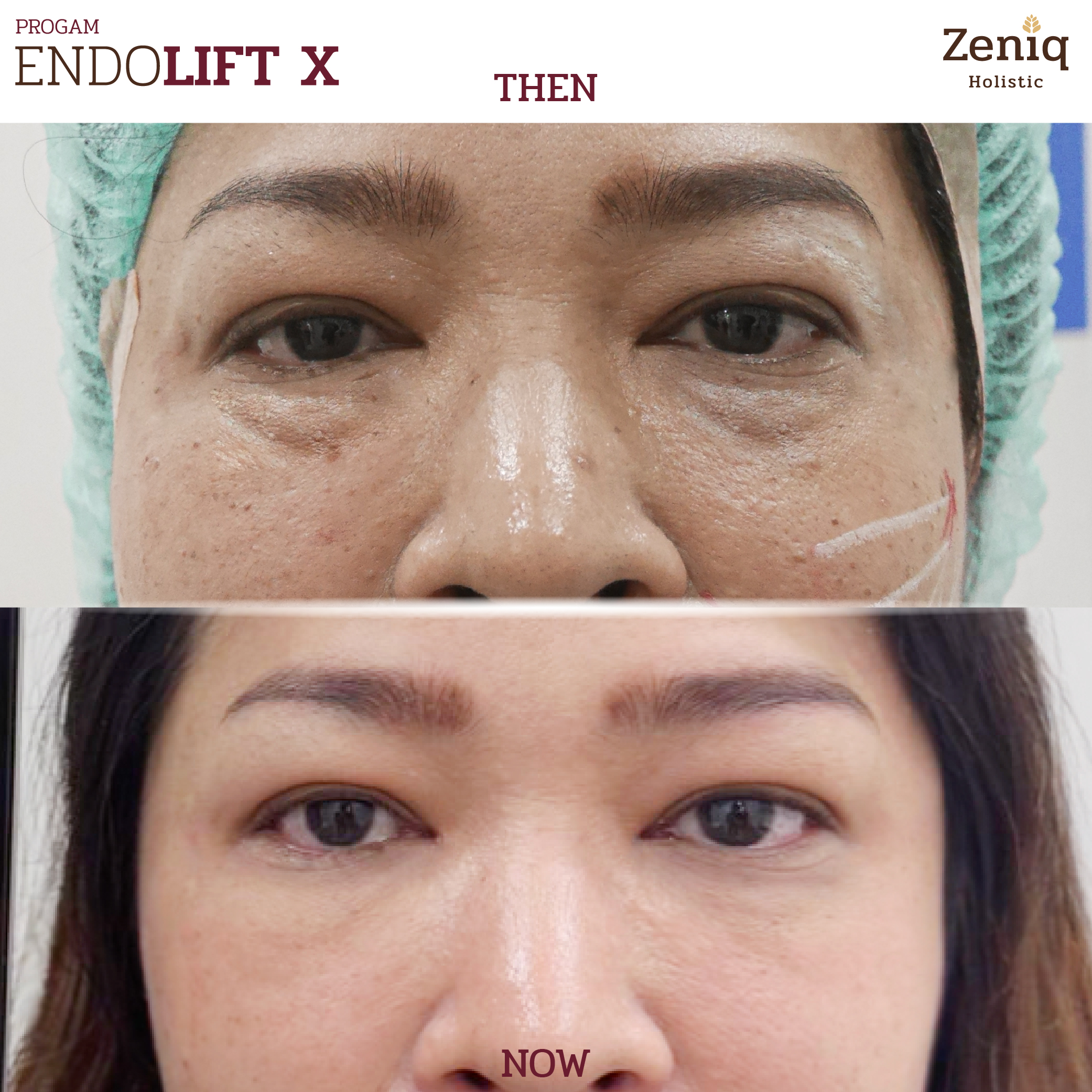 รีวิวผลลัพธ์ความงาม Zeniq Holistic กรุงเทพ
